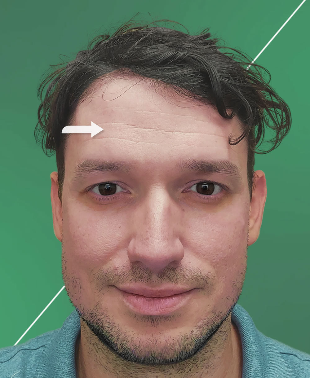 Before Krete serum usage: man with age wrinkles.